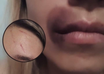 La joven de Clarke agredida mostró sus heridas: «Me atacaron de manera salvaje»