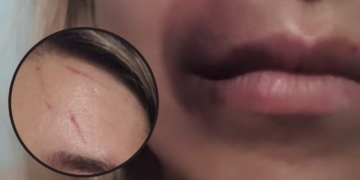 La joven de Clarke agredida mostró sus heridas: «Me atacaron de manera salvaje»