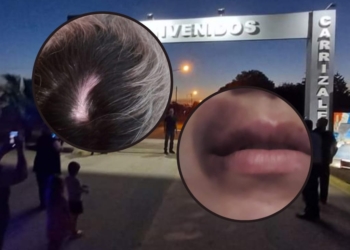 La joven de Clarke agredida sufrió aneurisma cerebral: «Milagrosamente puedo contarlo»