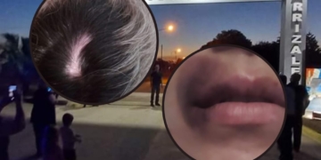 La joven de Clarke agredida sufrió aneurisma cerebral: «Milagrosamente puedo contarlo»