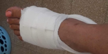 Maciel: salió a hacer compras, la mordió el perro de su vecina y tuvieron que suturarla