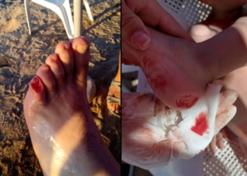 Alerta palometas: graves heridas por ataques en el Río Coronda