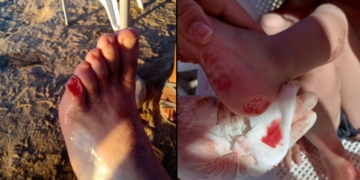 Alerta palometas: graves heridas por ataques en el Río Coronda
