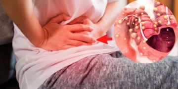 Totoras realizará una campaña de prevención y detección de cáncer de colon 