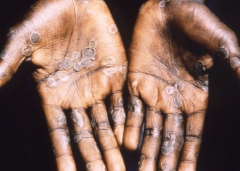 Confirmaron el primer caso de viruela del mono en Argentina y hay otro sospechoso