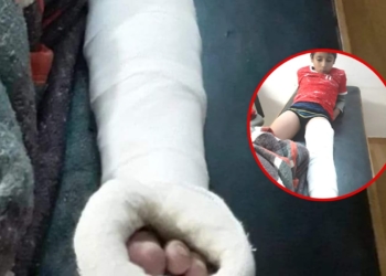 Un futbolista de 9 años sufrió doble fractura en Serodino y lo atendieron tras 5 horas