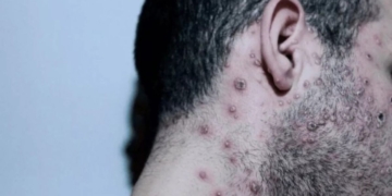 Confirmaron el primer caso de viruela de mono en la provincia de Santa Fe