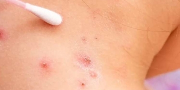 Confirmaron el segundo caso de viruela del mono en Rosario