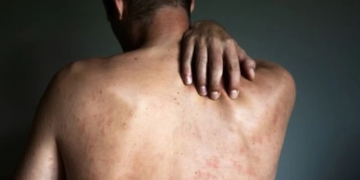 Reportaron el cuarto caso de Viruela del Mono en la provincia