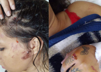 La joven atropellada en Timbúes se recupera de las heridas: «La puedo contar»