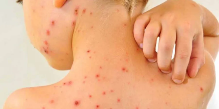 Un colectivo en el que viajaba una familia con Sarampión paró en Totoras y se activó el protocolo sanitario