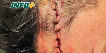 Un jugador terminó con más de diez puntos de sutura tras un incidente en la Liga Galvense