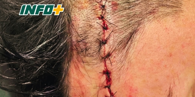 Un jugador terminó con más de diez puntos de sutura tras un incidente en la Liga Galvense